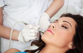 îndepărtarea negilor cu laser