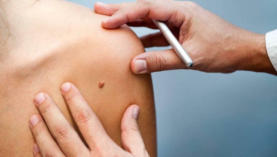 Dermatolog care examinează un pacient cu papilom