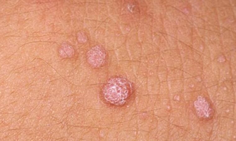 HPV duce la apariția papiloamelor cutanate