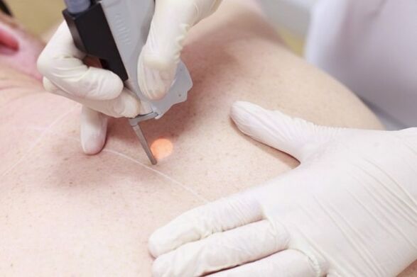 O metodă populară pentru îndepărtarea papiloamelor cu laser
