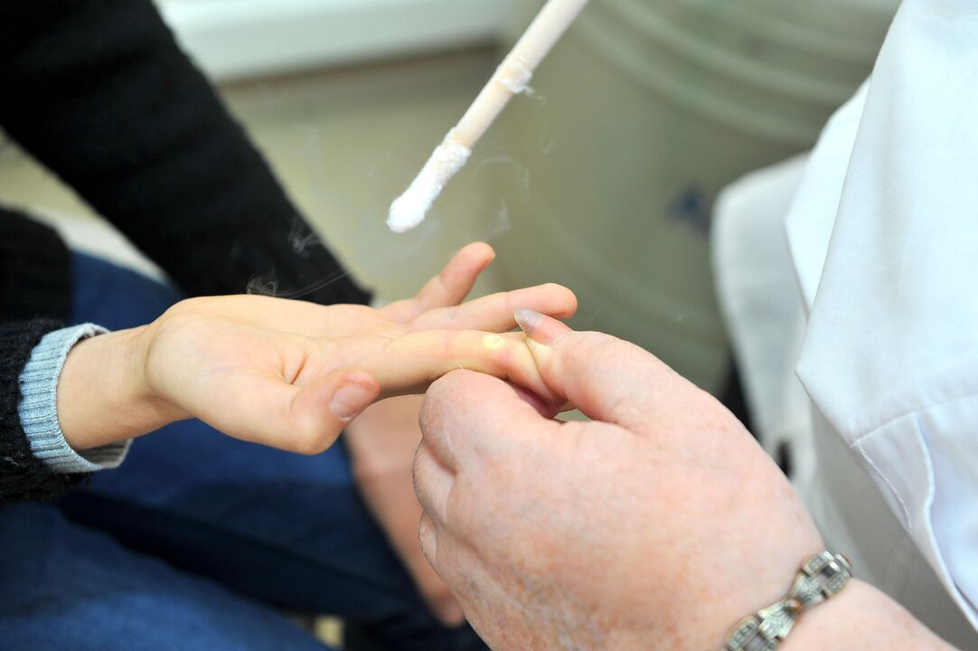 perioada de recuperare după îndepărtarea negilor
