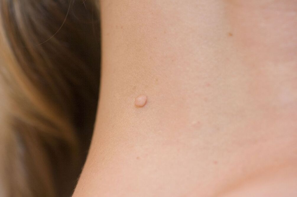 Simptome HPV