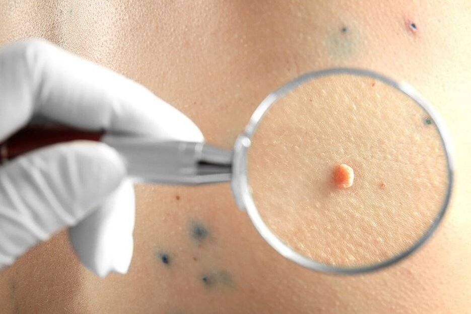 Tratamentul HPV