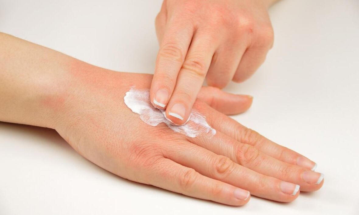 tratamentul psoriazisului cu crema Keramin